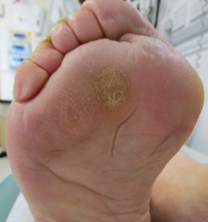 callous on the sole of the foot